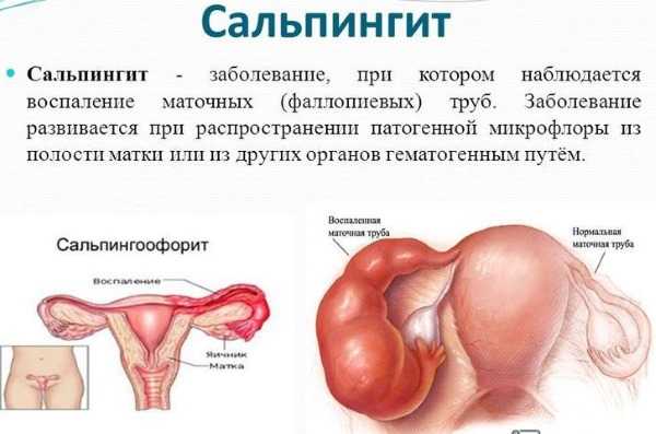 Аденомиоз матки - что это такое у женщин и как лечить, причины, симптомы, признаки аденомиоза тела матки на узи