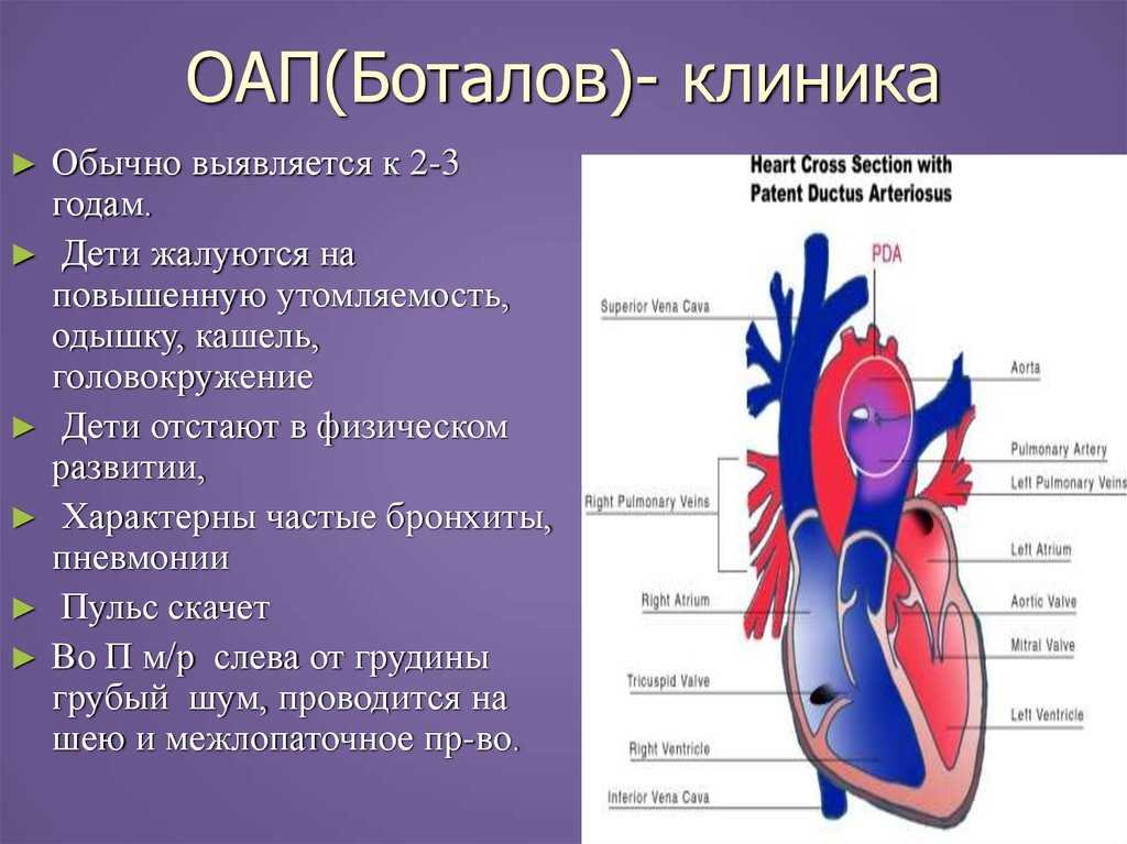 Оап у детей: лечение открытого артериального протока | клиника хадасса