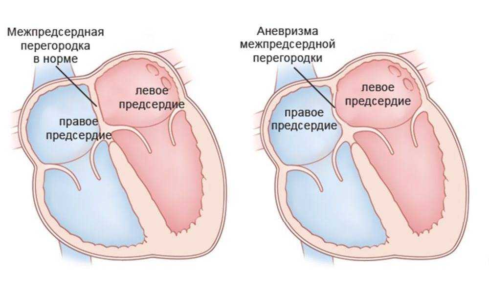 Врождеhhые пороки сердца