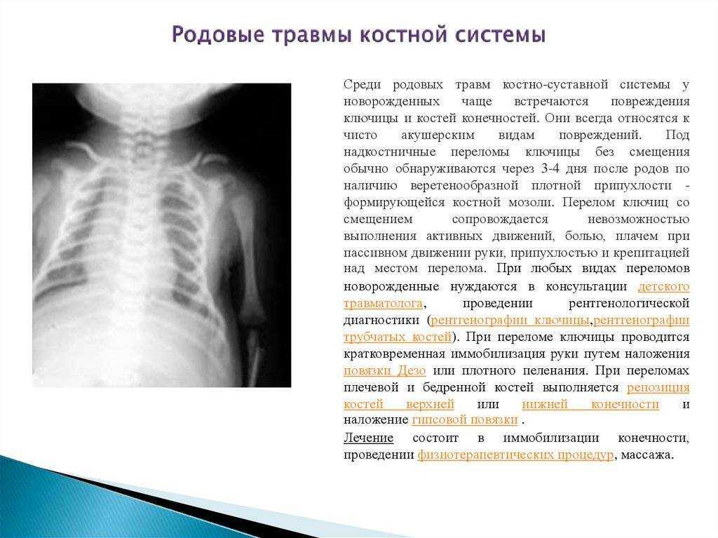 Лечение перелома или вывиха ключицы у новорожденного ребенка при родах и возможные последствия