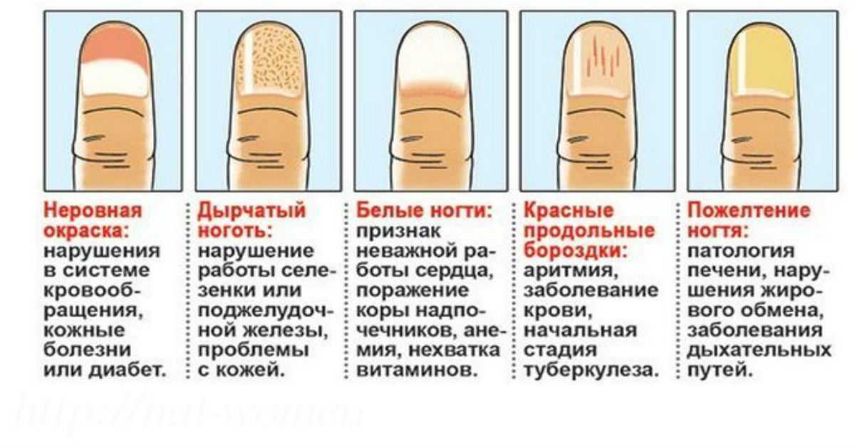 Причины деформации ногтей на руках