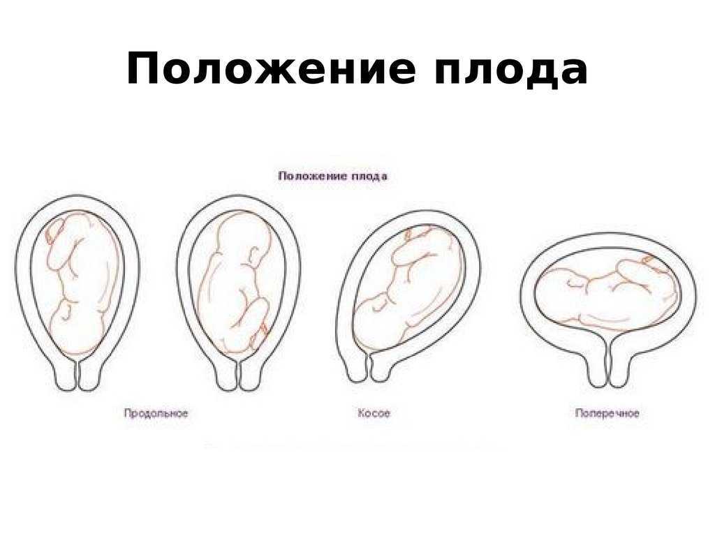 Головное предлежание плода: причины, симптомы, риски и способы профилактики