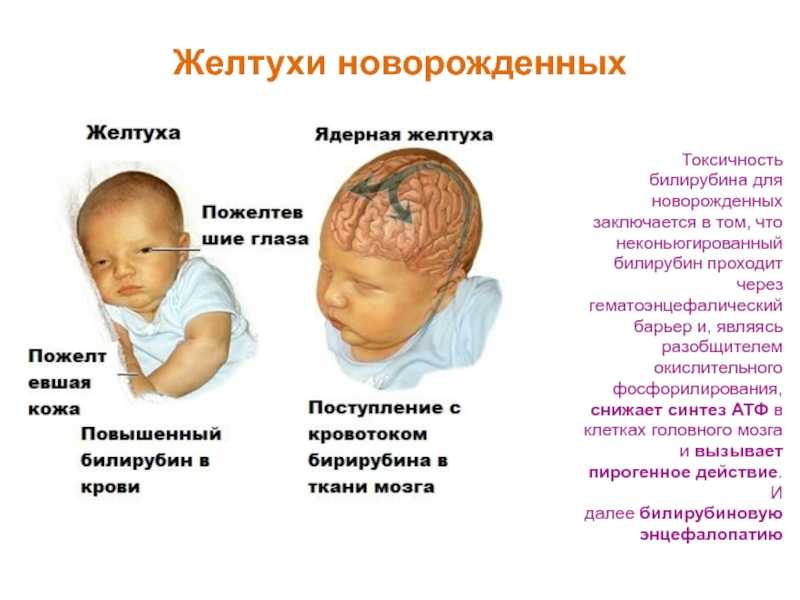 Ребенок желтуха почему. Показатели при физиологической желтухе новорожденных. Патологическая желтуха у новорожденных билирубин. Симптомы желтушки новорожденного. Токсичность билирубина. Желтуха новорожденных..