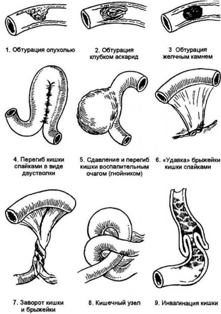 Кафедра факультетской хирургии пспбгму. острая кишечная непроходимость. часть 5.