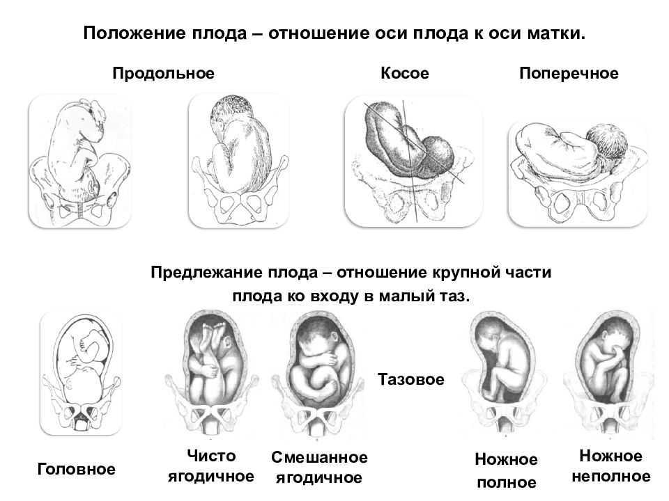 Предлежание плаценты