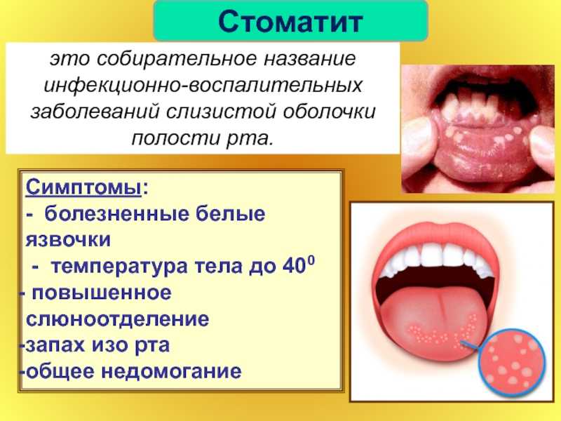 Герпес на губе  и другие типы герпетической инфекции