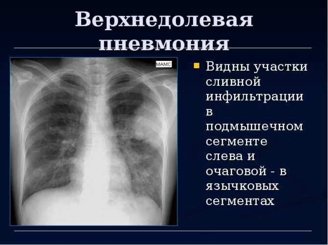 Первые признаки пневмонии у детей, как их распознать и диагностировать