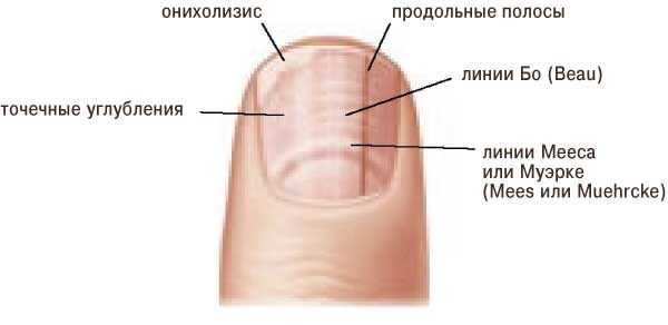Неровные ногти: почему на них появляются точки, бугорки и бороздки