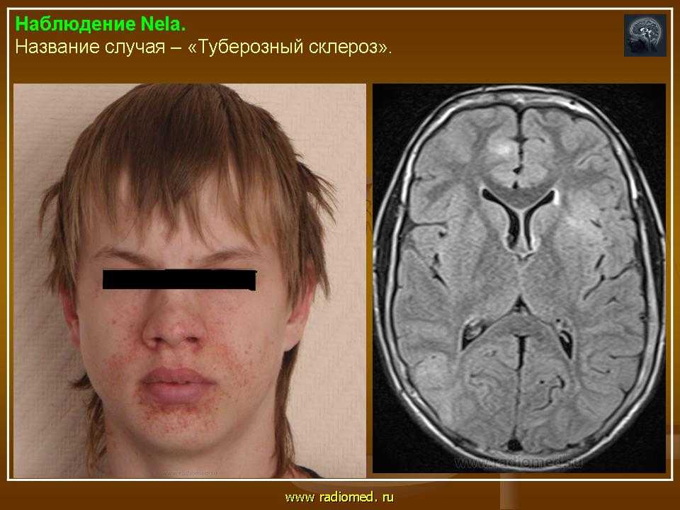 Мрт и кт головного мозга. кт и мрт диагностика болезни бурневиля-прингла