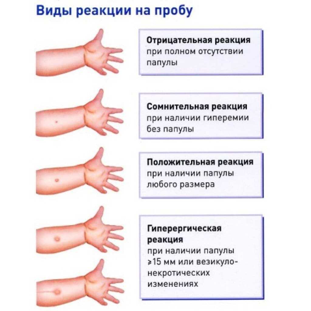 Техника проведения пробы манту: алгоритм введения туберкулина, показания, противопоказания, результаты, можно ли делать ребенку
