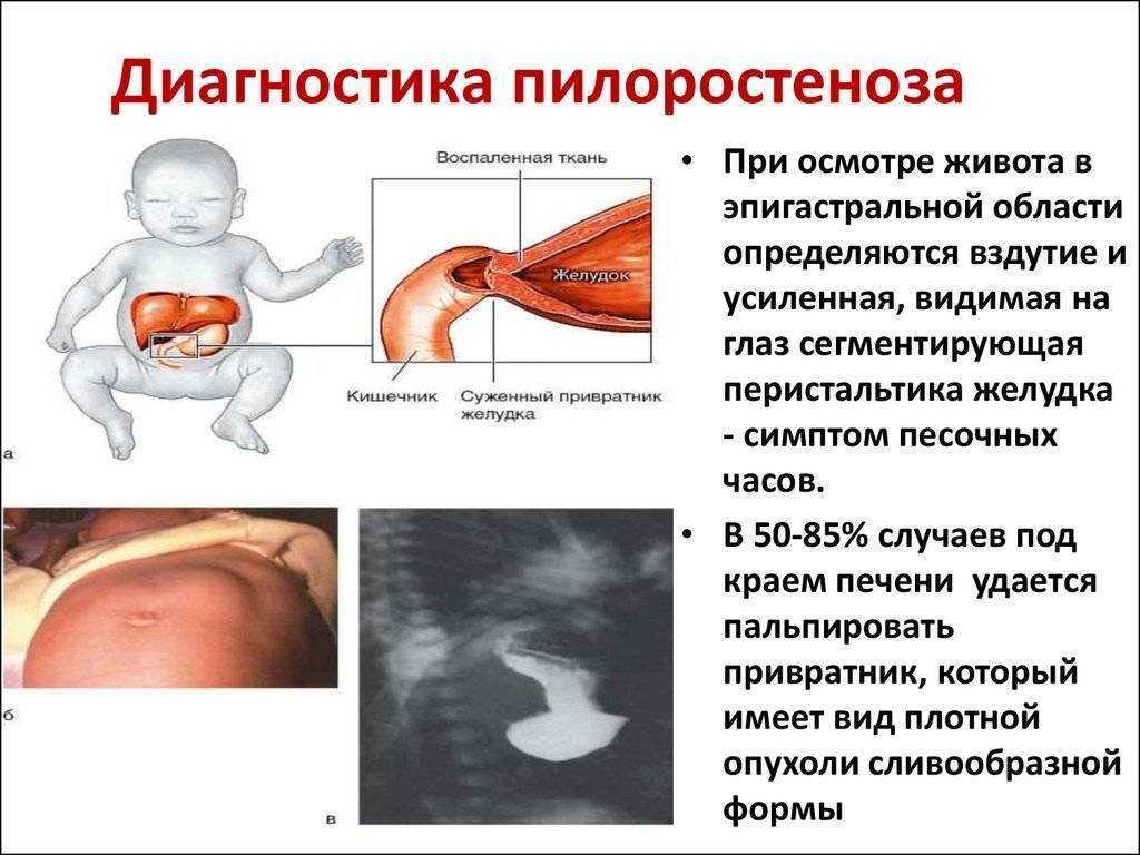 Симптоматика пилороспазма и пилоростеноза у новорожденных и грудных детей, диагностика и лечение