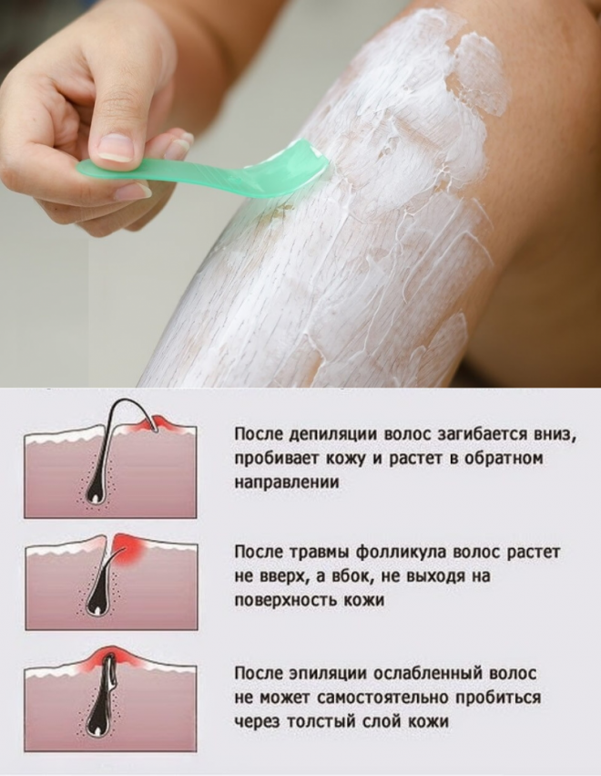 Шугаринг бикини
