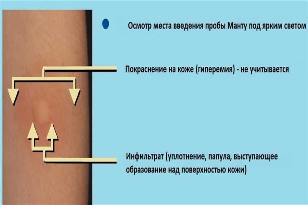 Можно ли делать манту при насморке детям