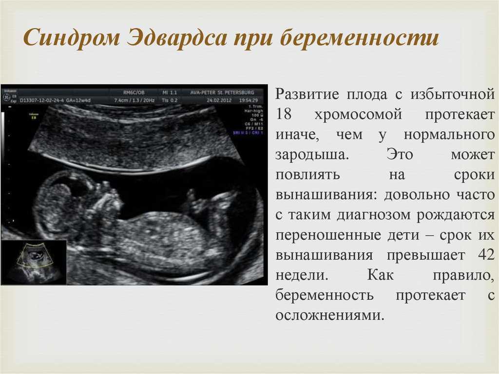 Детский церебральный паралич: основные причины и признаки заболевания