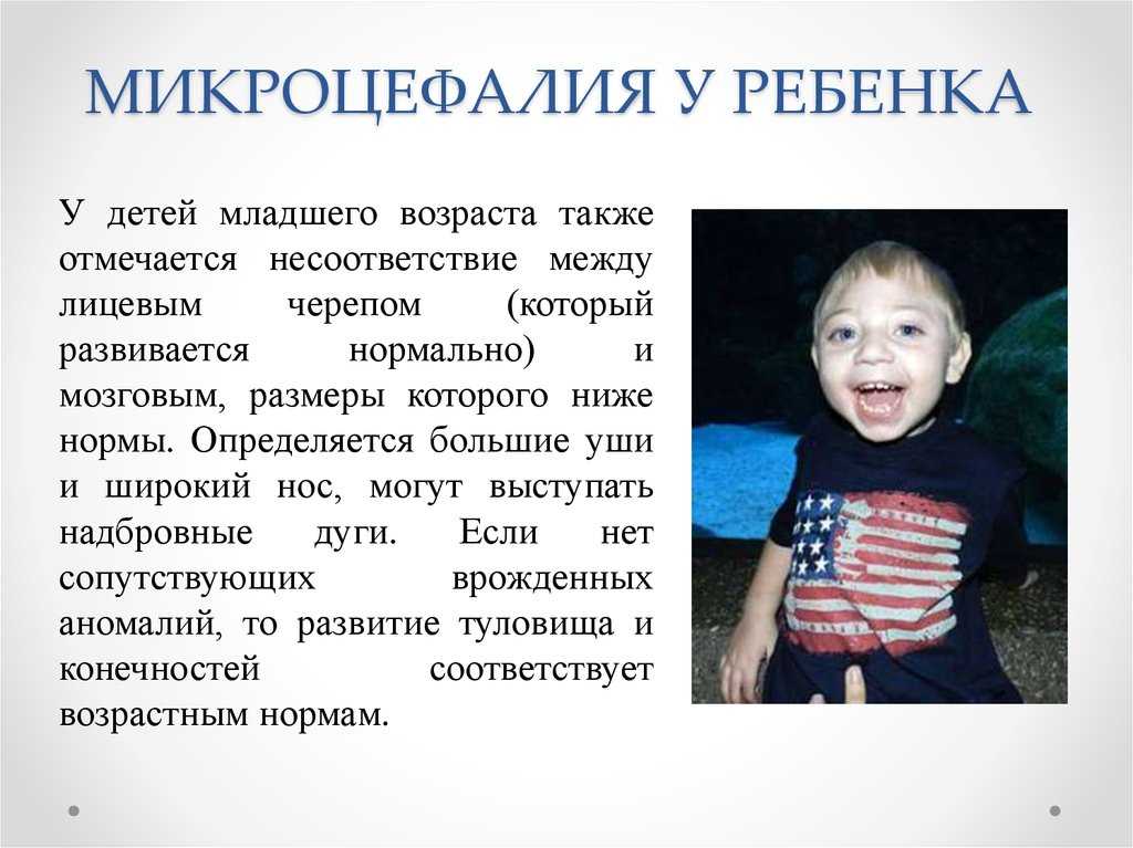 Микроцефалия - признаки, причины, симптомы, лечение и профилактика - idoctor.kz