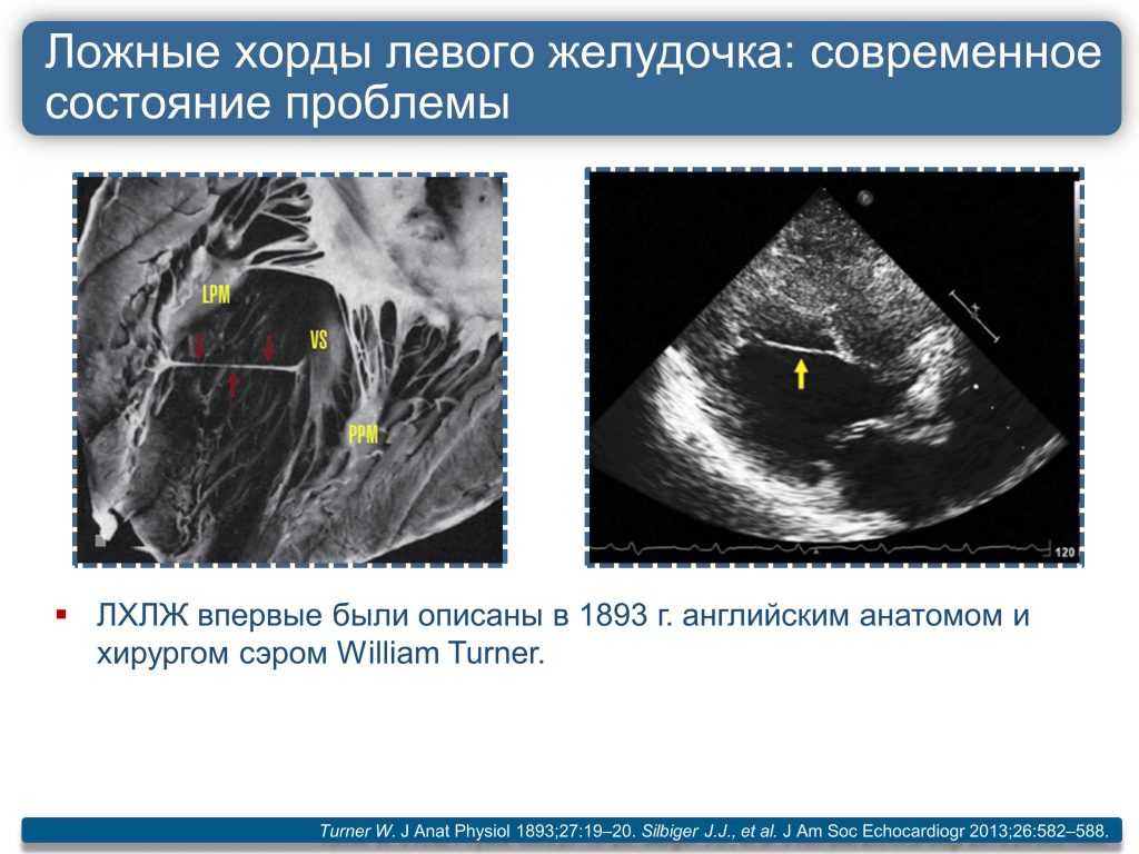 Дополнительная хорда в сердце: что это такое, классификация, симптомы, лечение и прогноз