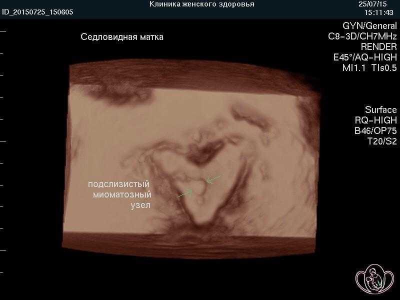 Двурогая матка форум. Седловидная матка на 3 д УЗИ. Двурогая седловидная матка. Седловидная форма матки на УЗИ. Двурогая матка на УЗИ.