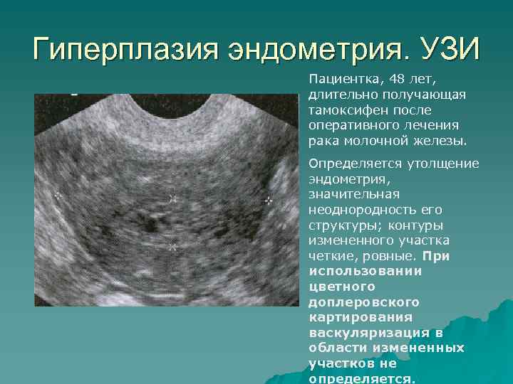 Полипы матки, влагалища, вульвы: симптомы, диагностика, лечение