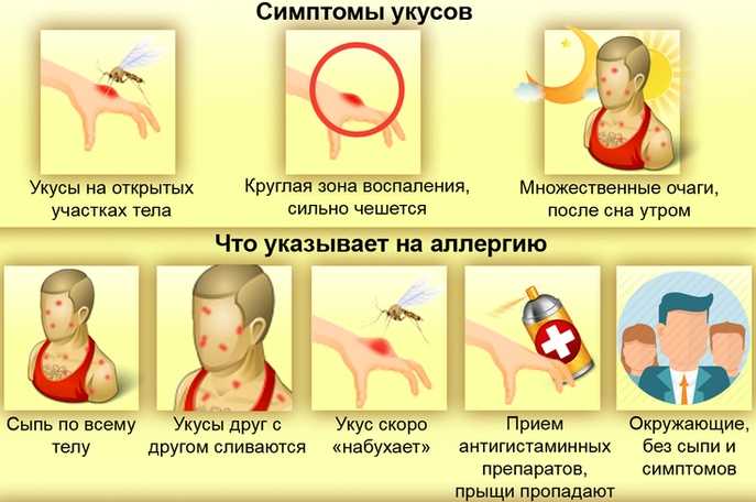 Укусы клопов у детей: как выглядят, симптомы, лечение