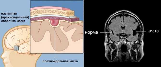 Сперматоцеле (киста яичка), симптомы и последствия. удаление кисты яичка.
