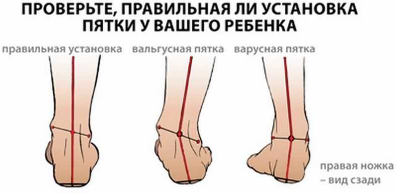 Особенности ортопедических стелек для детей при лечении вальгусной деформации стоп