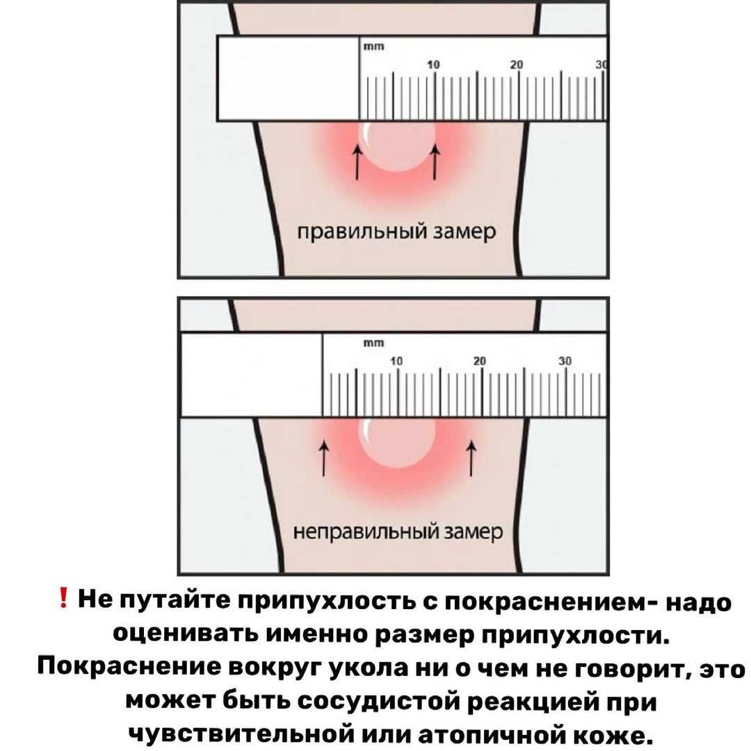 Какая должна быть отрицательная манту. Реакция манту норма у детей 2 года размер норма. Реакция манту показатели нормы. Норма размера реакции манту в 5 лет.