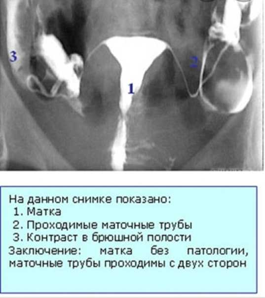 Гистеросальпингография: показания и описание процедуры