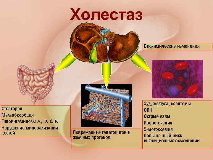 Холестаз это. Холестаз мальабсорбция. Внутри печеночной холестаза. Холестатическое поражение печени.