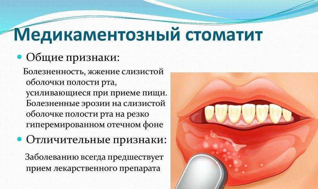 Для полости рта характерно. Афтозный и язвенный стоматит. Стоматит воспаление десен. Герпетиформный стоматит. Стрептококковый стоматит.