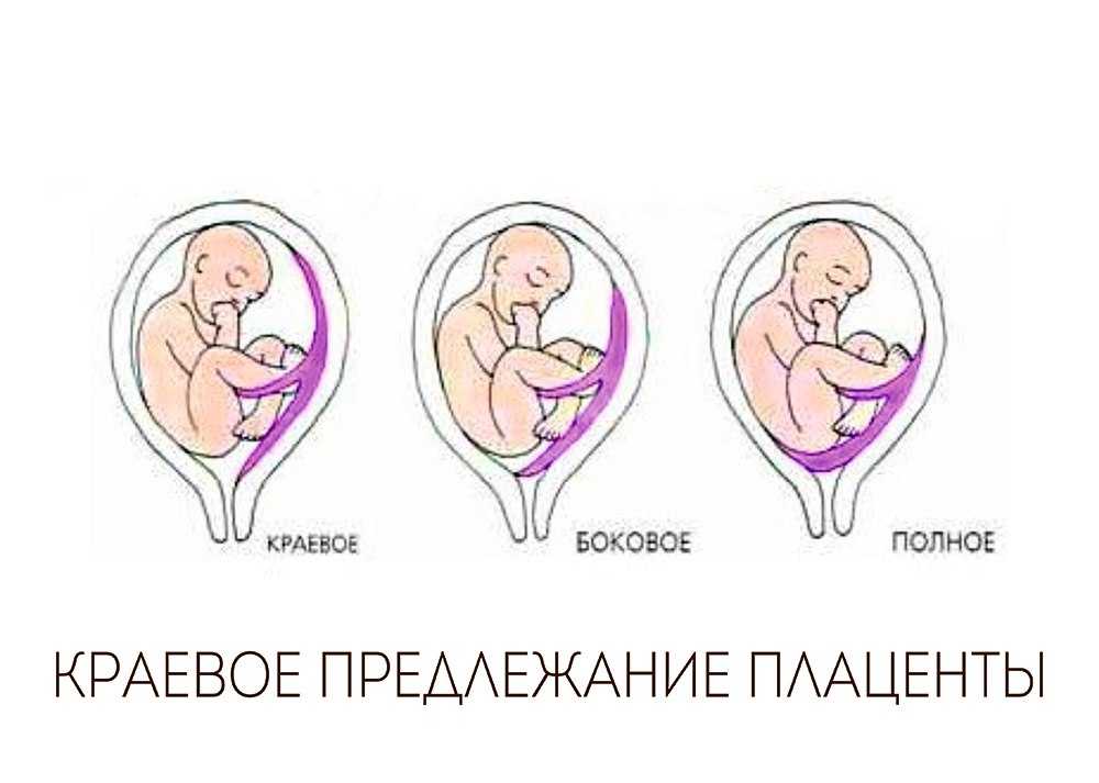 Краевое предлежание плаценты по задней стенке или передней: прогноз родов при опасном диагнозе