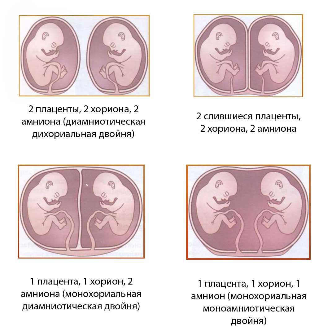 Что такое монохориальная диамниотическая двойня, чем отличается от дихориальной и моноамниотической