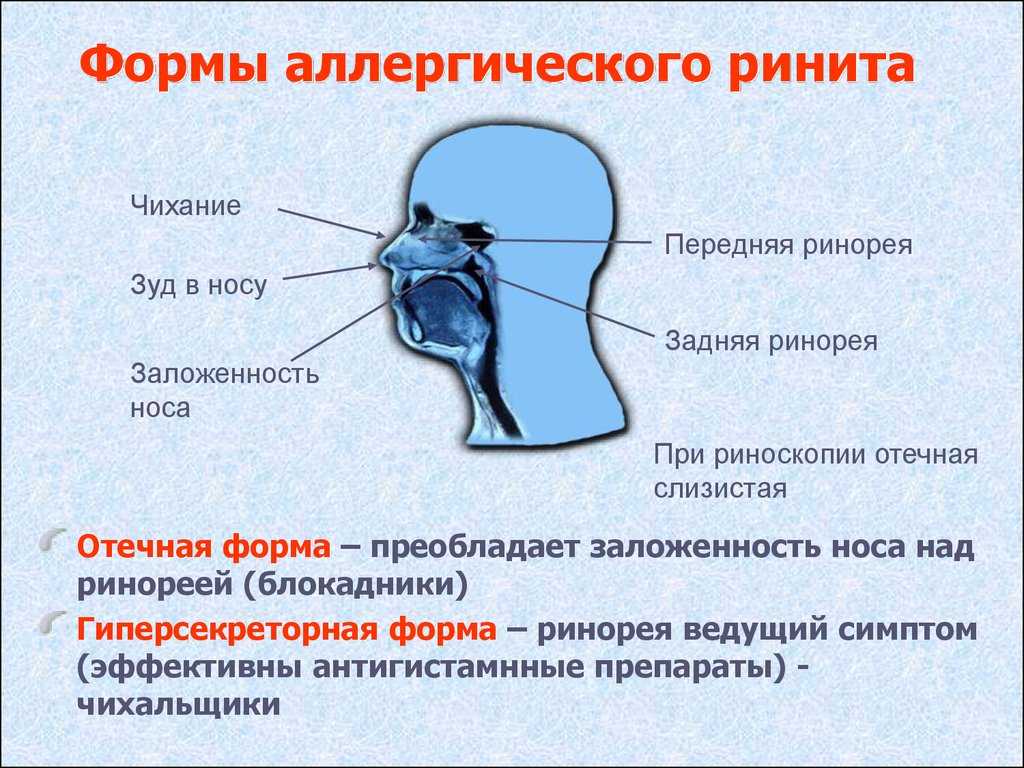 Ринит симптомы и лечение. Аллергический ринит симптомы. Симптомы аллергического ринита. Симптомы аллергического ринита у взрослых. Основные симптомы аллергического ринита.