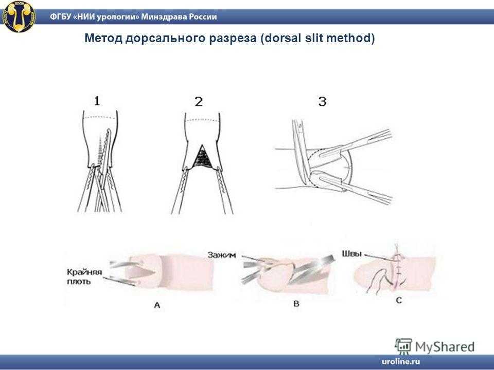 Обрезание у детей схема операции