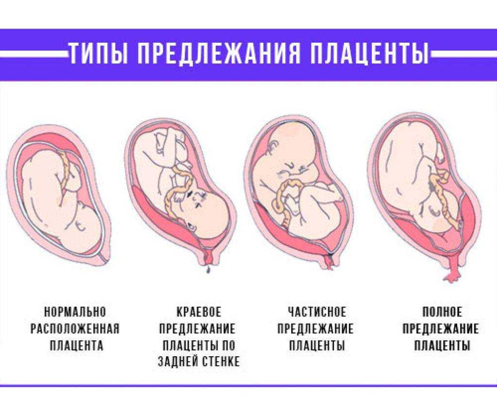 Плацента по задней стенке. Расположение плаценты норма внутреннего зева. Предлежание плаценты головное. Краевое прикрепление плаценты. Краевое предлежание плаценты у внутреннего зева.