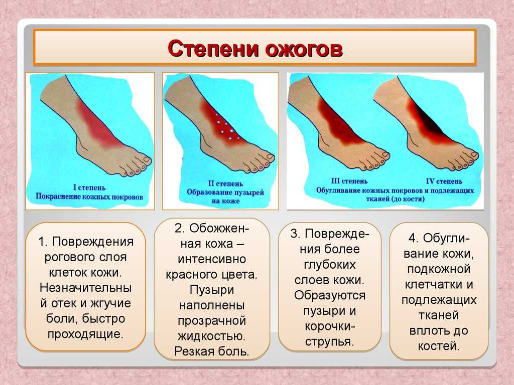 Помощь при ожогах картинки