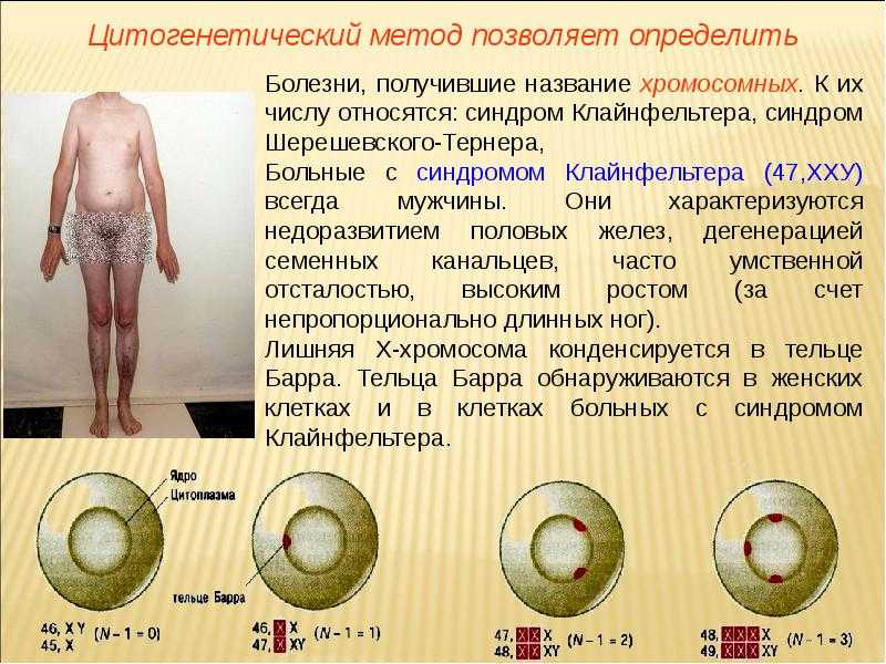 Синдром клайнфельтера: мужчина с женской хромосомой