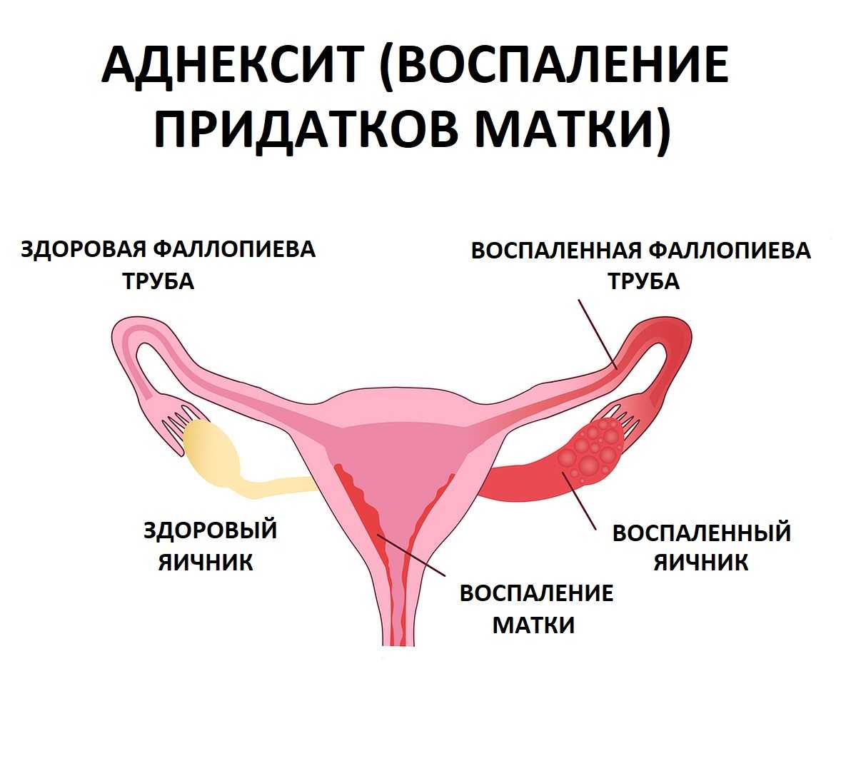 воспаление яичников у женщин фото