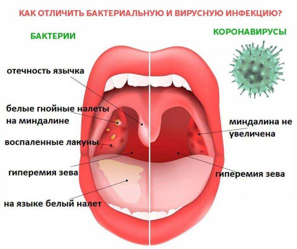 Тонзиллит острый и хронический: лечение тонзиллита у взрослого и ребенка