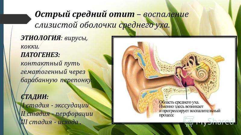 Средний отит