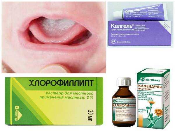 Стоматит: специфика и лечение
