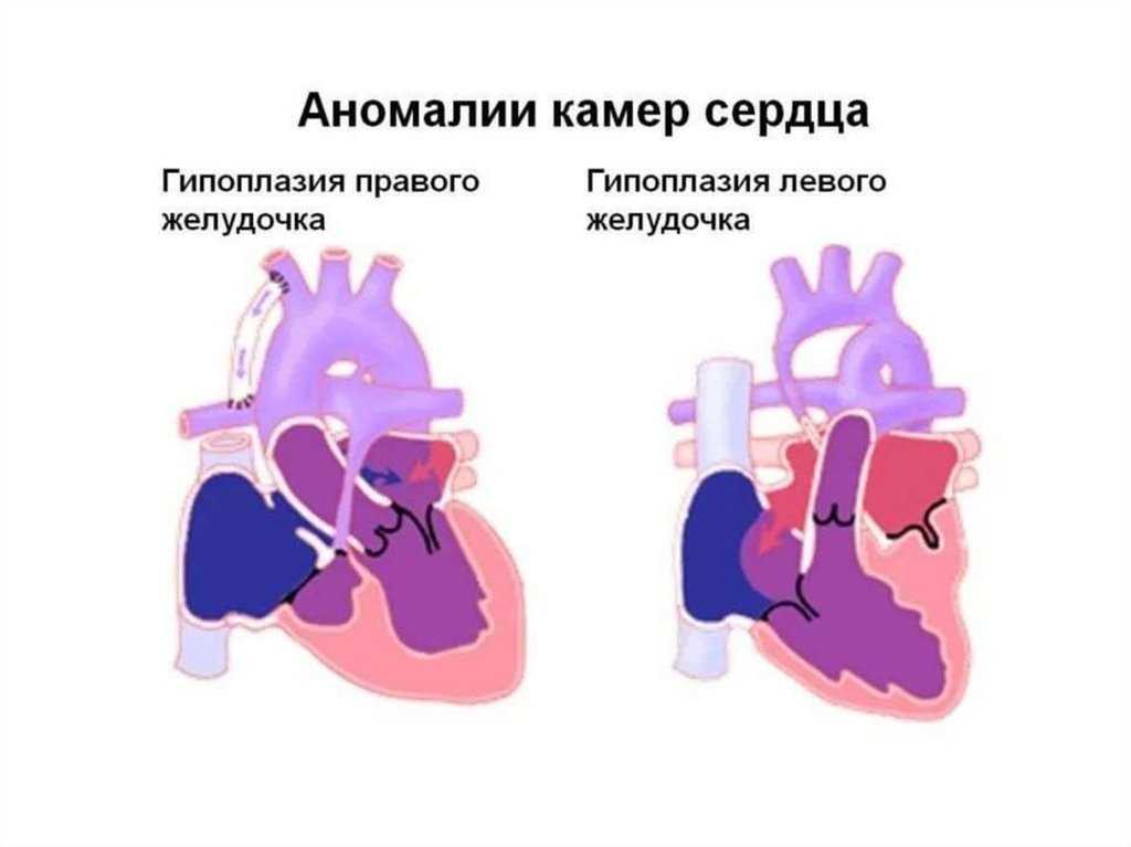Диагноз марс дхлж — сердце