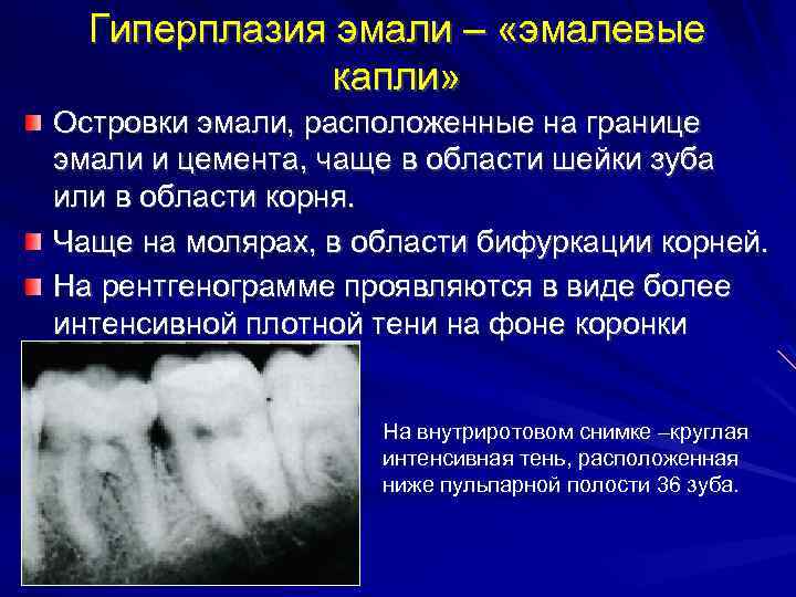 Гипоплазия эмали и клиновидный дефект зубов: причины и лечение - medside.ru