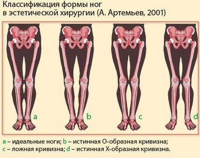 Что такое дисплазия тазобедренных суставов у детей: как проявляется, методы лечения патологии