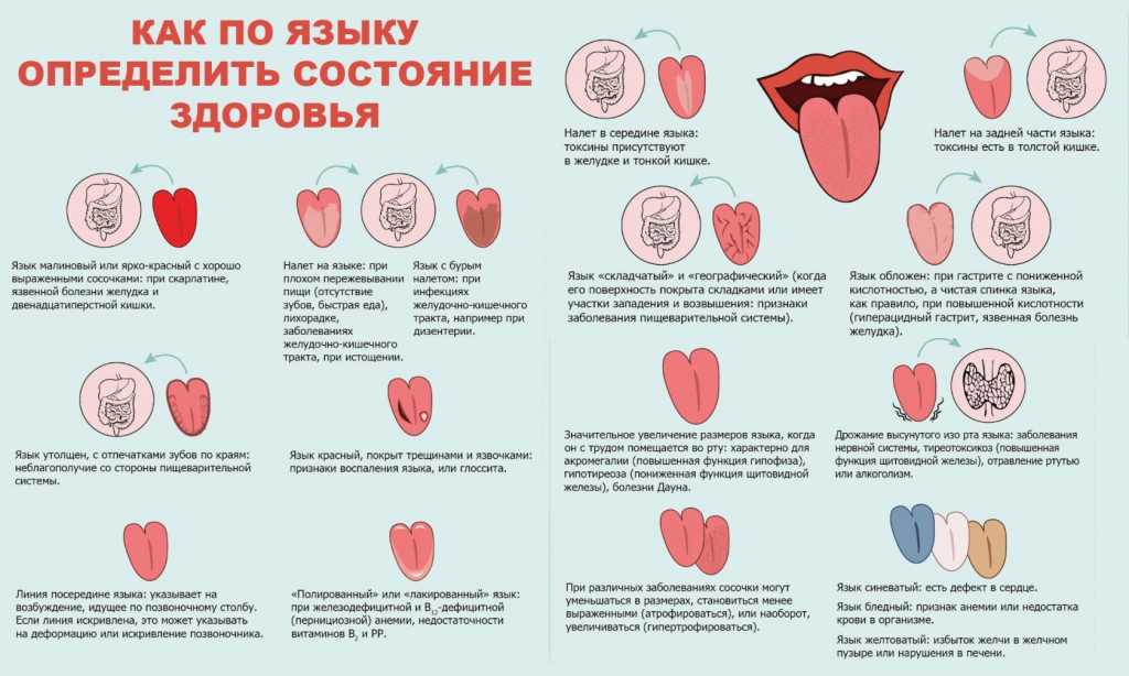 Налёт (пятна) на языке – норма или признак скрытой патологии?