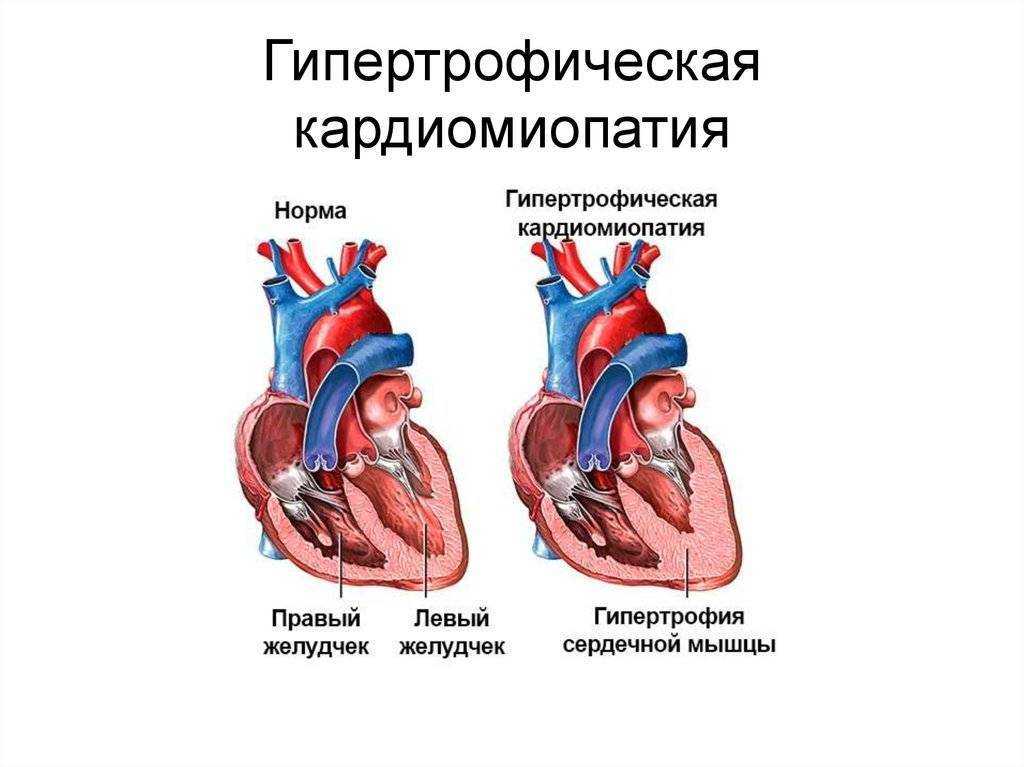 Что такое кардиопатия, по каким причинам она возникает у детей, каковы разновидности и симптомы этой патологии?