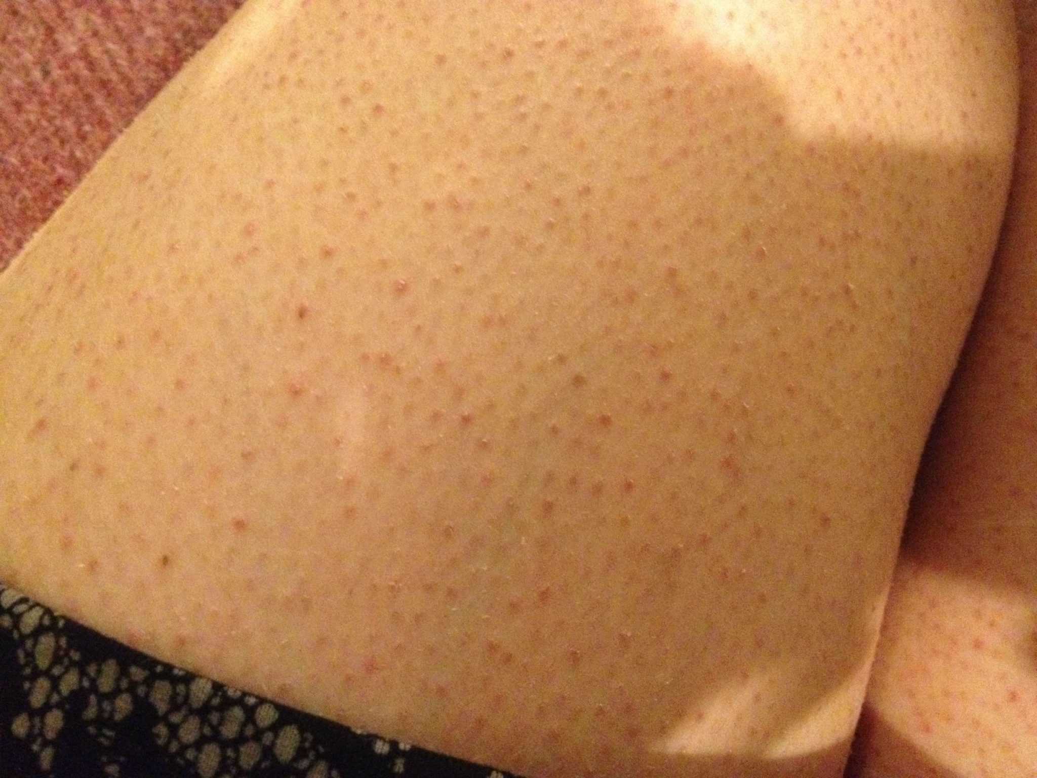 кожные высыпания на груди у женщин фото 106