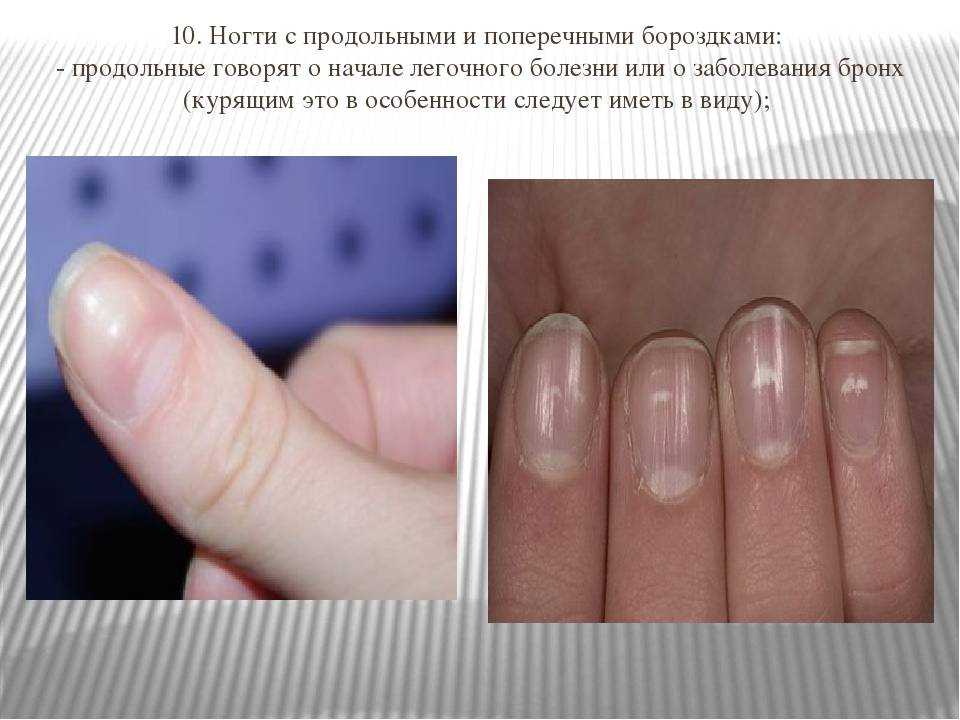 Причины деформации ногтей на руках