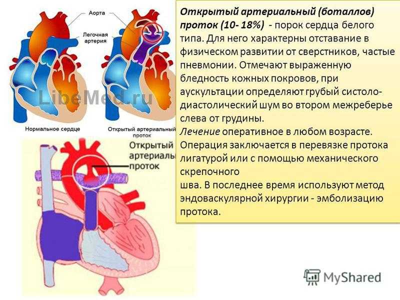 Открытый артериальный боталлов проток (оап): причины незаращения у детей, симптомы, как лечить