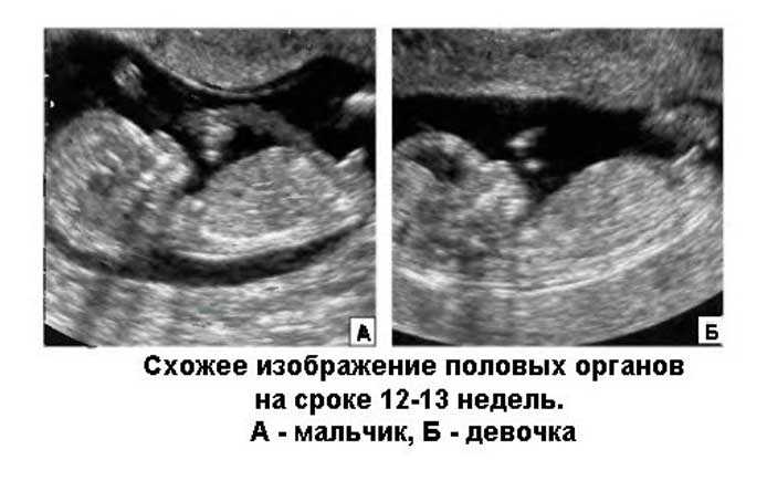 На каком сроке беременности можно определить пол ребенка