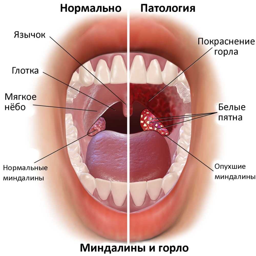 Ангина: ранние симптомы, признаки и способы лечения